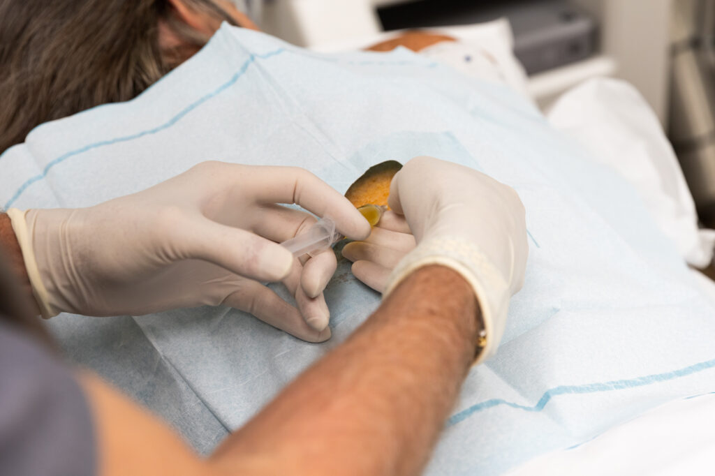 A provider injects PRP into a patient's back or prolotherapy near Sullivan's Island, SC.