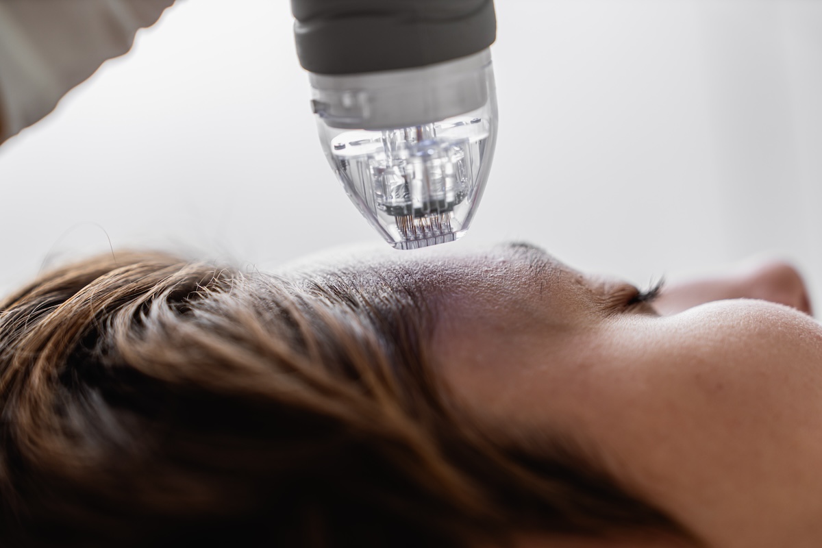 A patient undergoes microneedling, one of many aesthetic uses for PRP in Charleston.